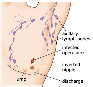 Male Breast Cancer Lump