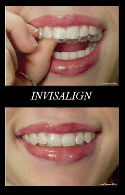 Tooth Whitening Laser Tooth Whitening Excellent Information For Tooth Whitening Average Cost Of Braces For Teeth