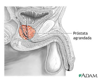 próstata vikipedia