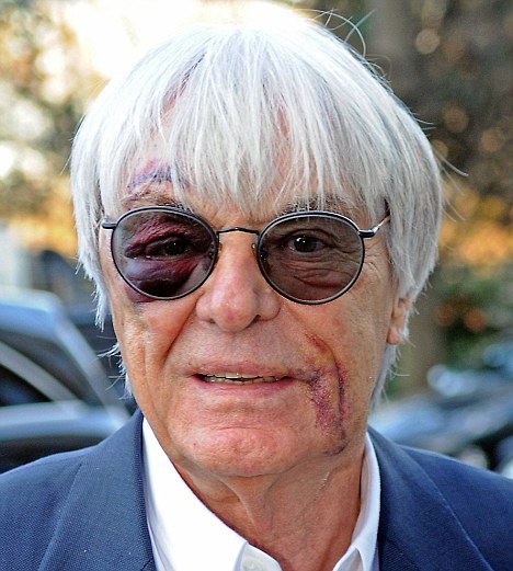 Formula%2B1%2BBernie%2BEcclestone%2Bshows%2Bhorrific%2Bblack%2Beye.jpg