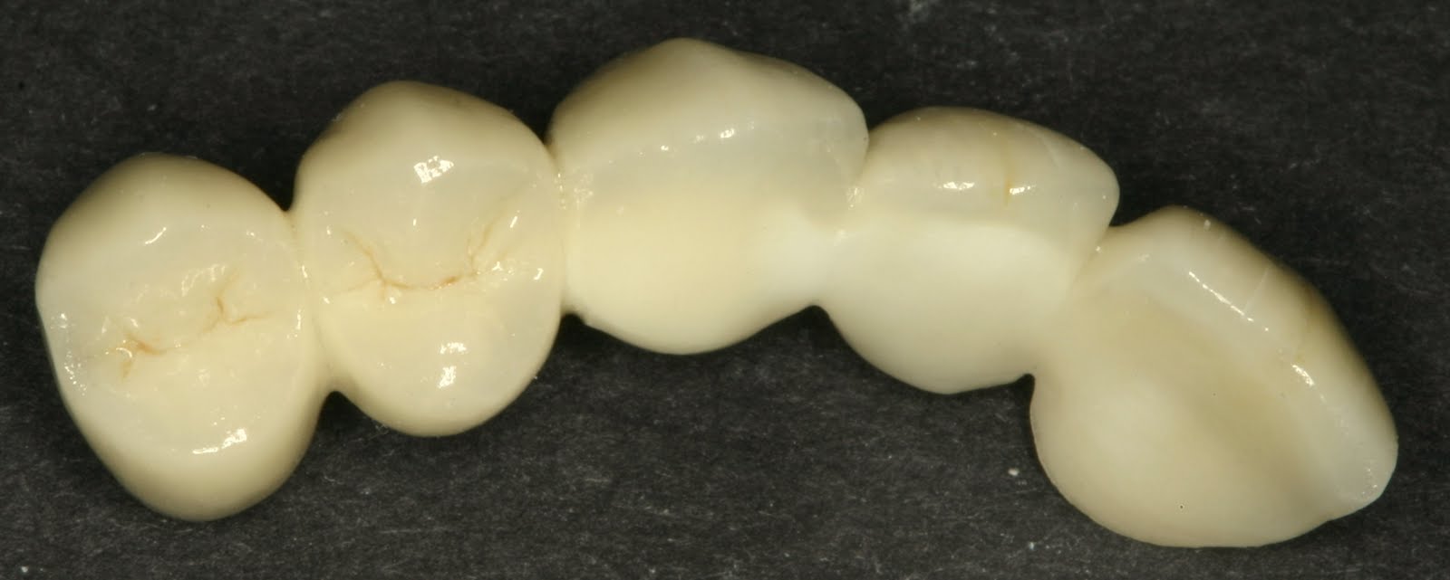 Beautiful Smiles Zirconia AllCeramic Bridge