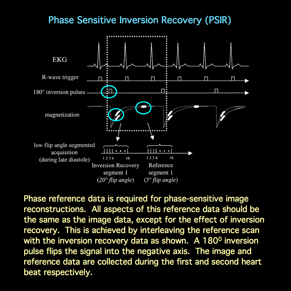 Inversion Time Graphical Psir Cardiac Mri _ Magnetic Resonance Imaging (MRI) of the Heart – JMLEFI
