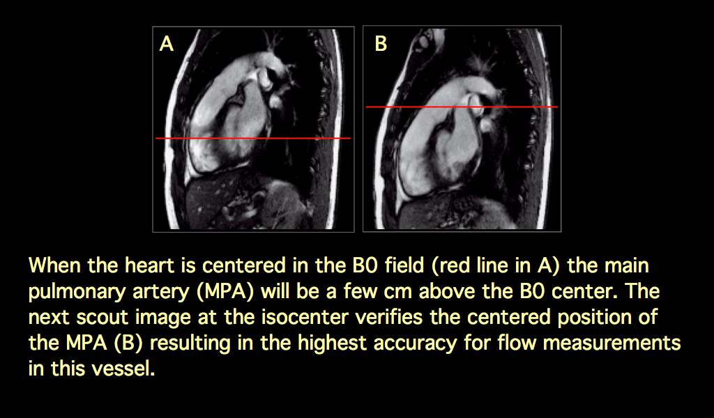 MRI BLOG Flow Measurement in Main Pulmonary Artery