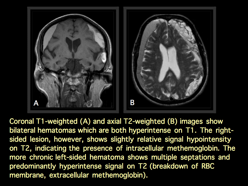 Weighted blood t1 mri T1 measurement