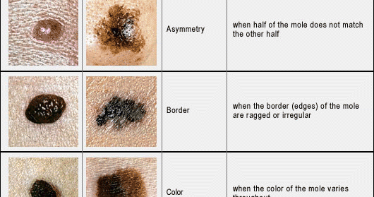 Doctors Gates: Melanoma Skin Cancer Pic and self-assessment lymphoma cancer diagrams 