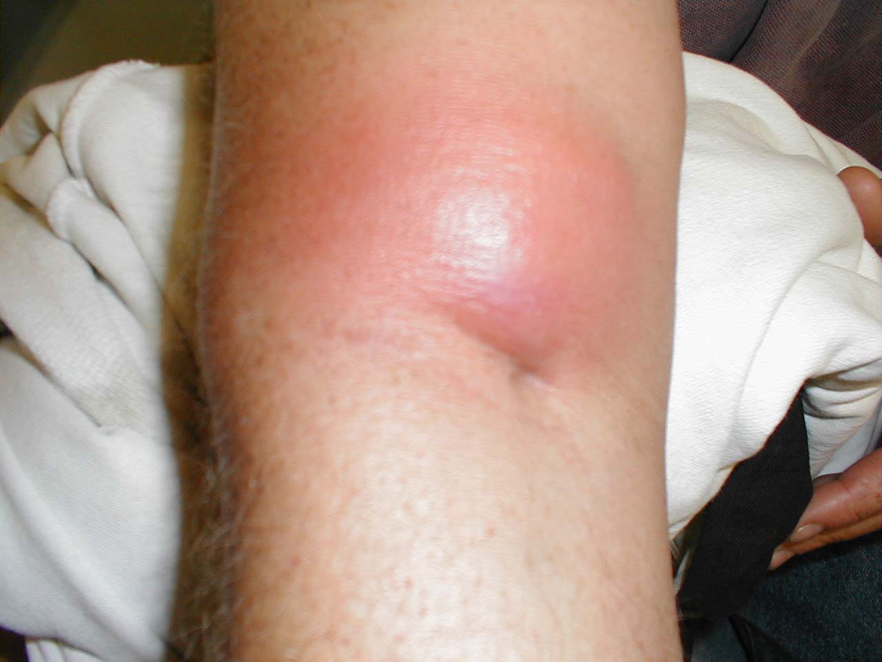 abscess from iv drug use