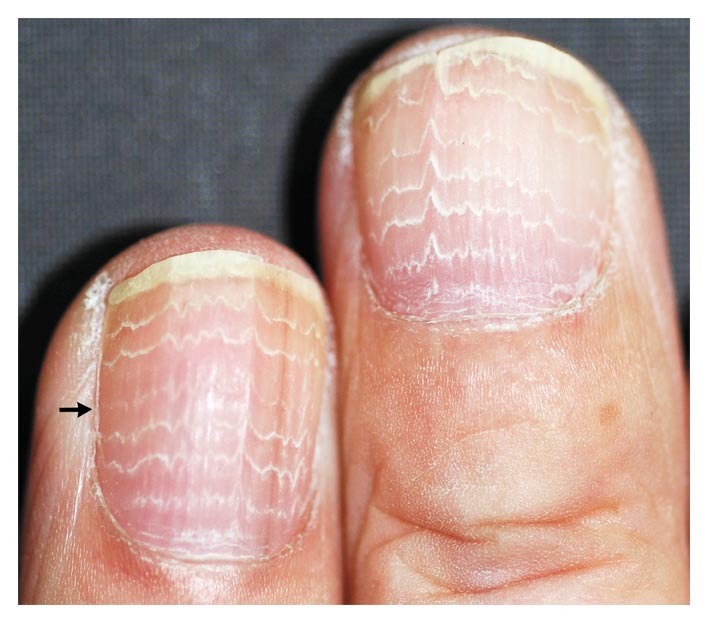 Dermatologic Manifestations of Glucagonoma Syndrome ...