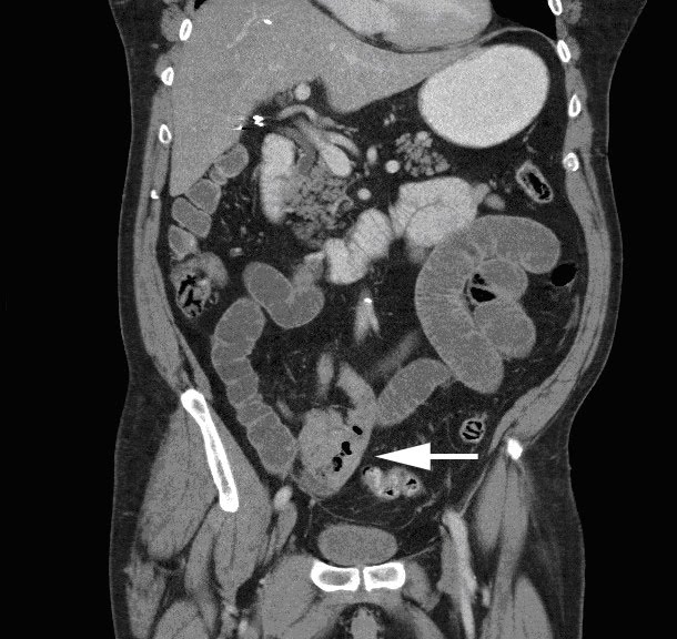 Doctors Gates: A case of male with abdominal pain (with CT & Pathology)