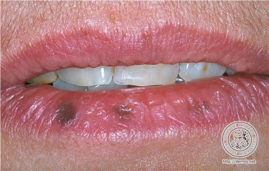 Dark Spots on Lips Causes, How to Get Rid of, Remove ...