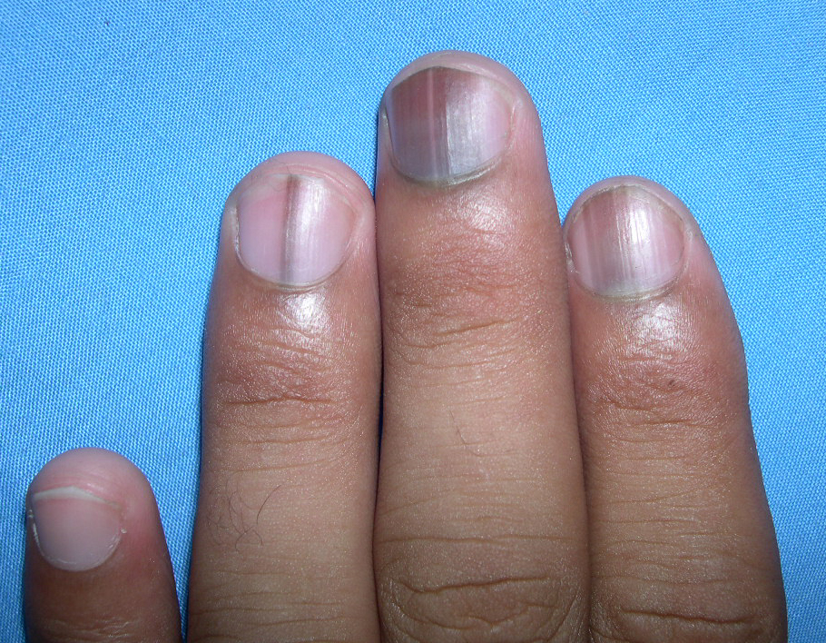 Почему ногти синеют причина. Продольная меланонихия. Подногтевая меланома поперечная. Коричневые полоски на ногтях.