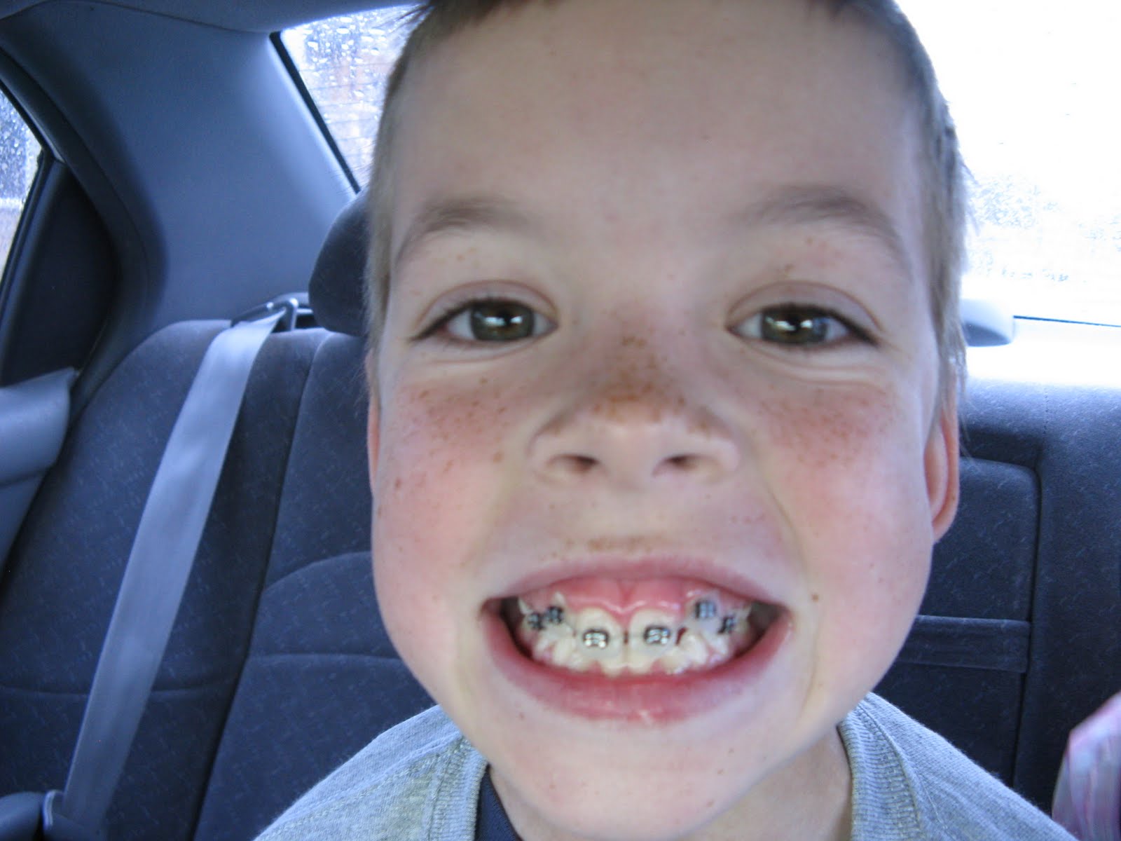 wendy will ramble... brace face metal mouth