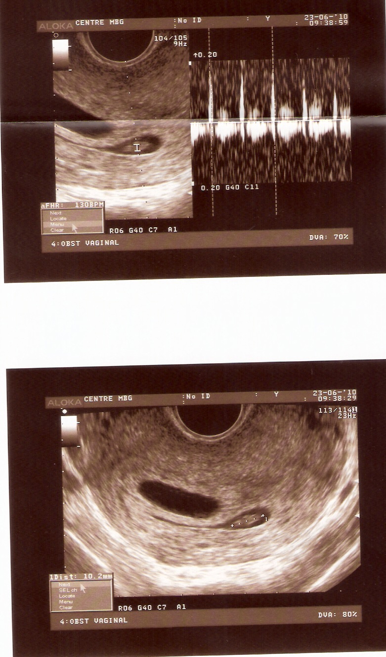 IN BTWIN Las ecografias de mis hermanos/ My brothers ultrasounds