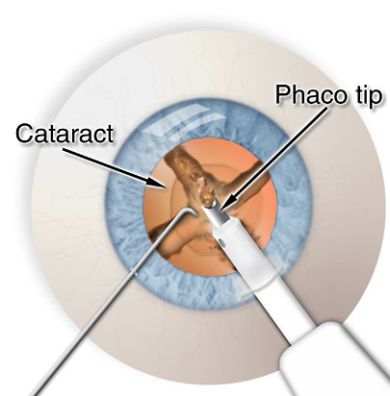 Замена хрусталика что нельзя делать после операции. Ультразвуковая факоэмульсификация катаракты. Операция на хрусталик глаза. Замена хрусталика операция.