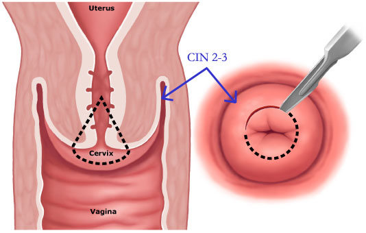 [Cone_biopsy2.jpg]