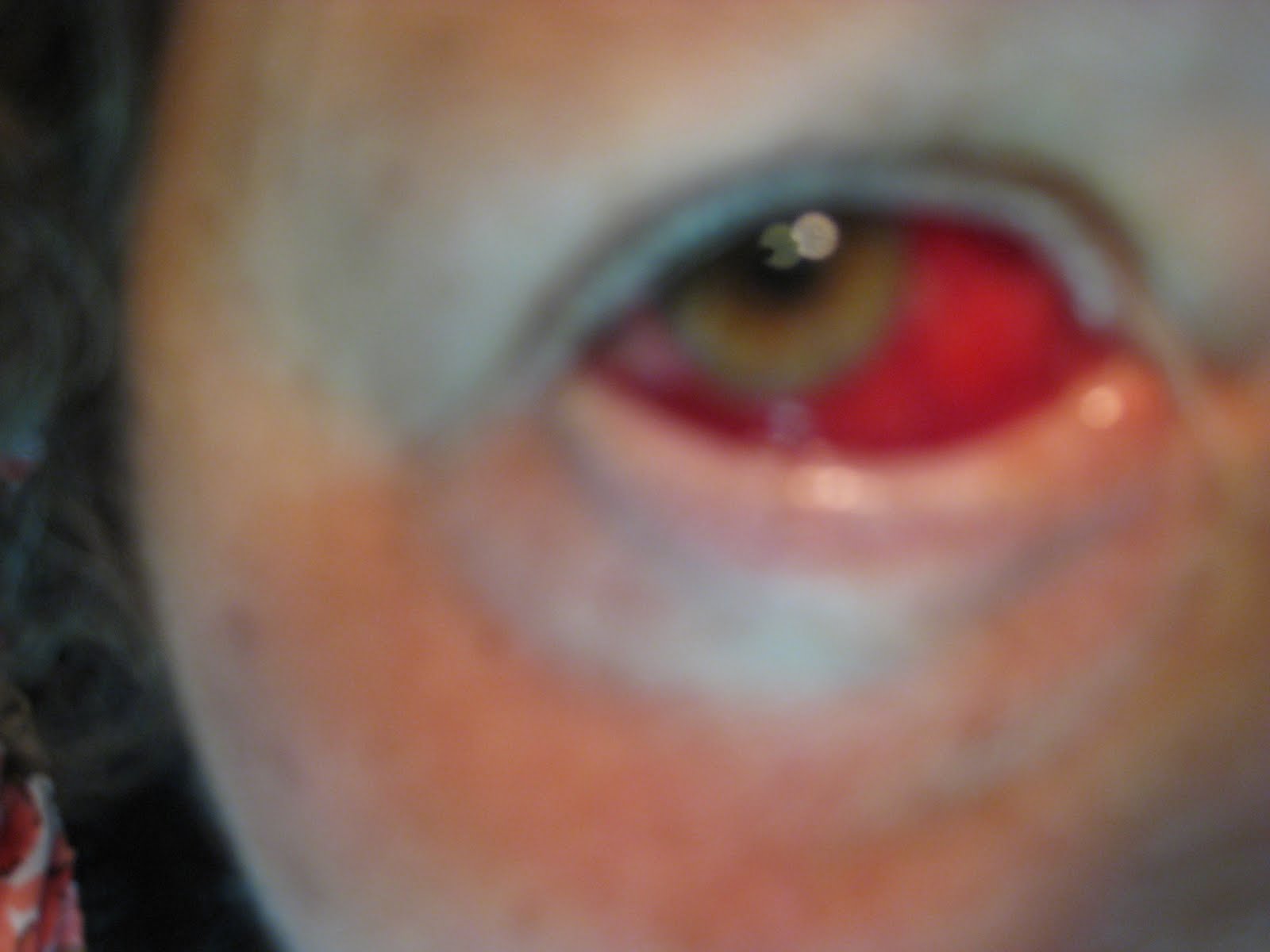 JUST ME: Red eye