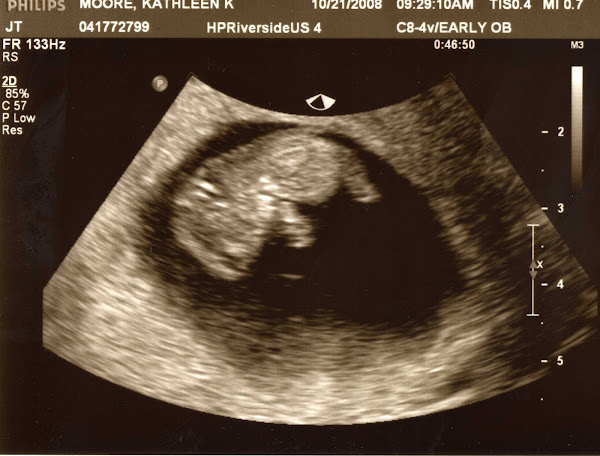 The baby at 9 and 1/2 weeks