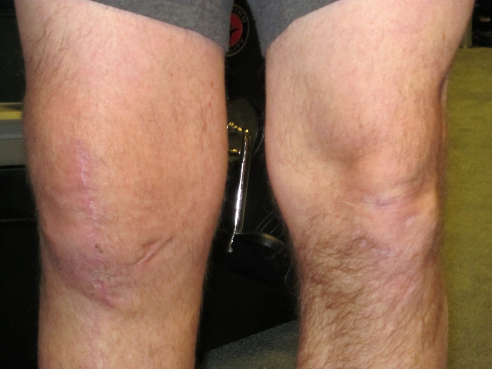 NMES for Quadriceps Rehab Post Knee Surgery TO NMES FOR