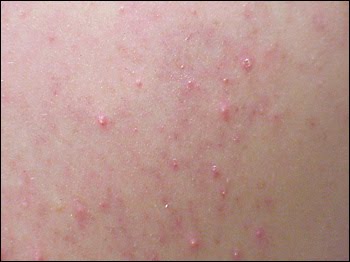 Morphea - Wikipedia