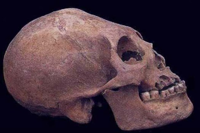 Deformation of the Human Skull WEB PICTURE