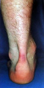 Tendinita ahileana (afectiune la tendonul lui Ahile) - Kinetic