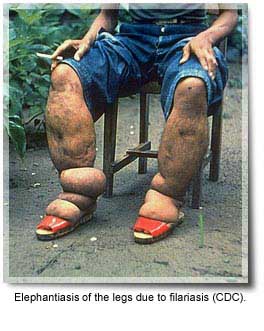 elephantiasis.jpg