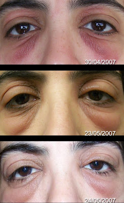 eye cream irritation