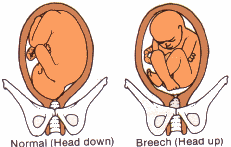 Pharmacy BreecH BaBy pharmacy-breech-baby