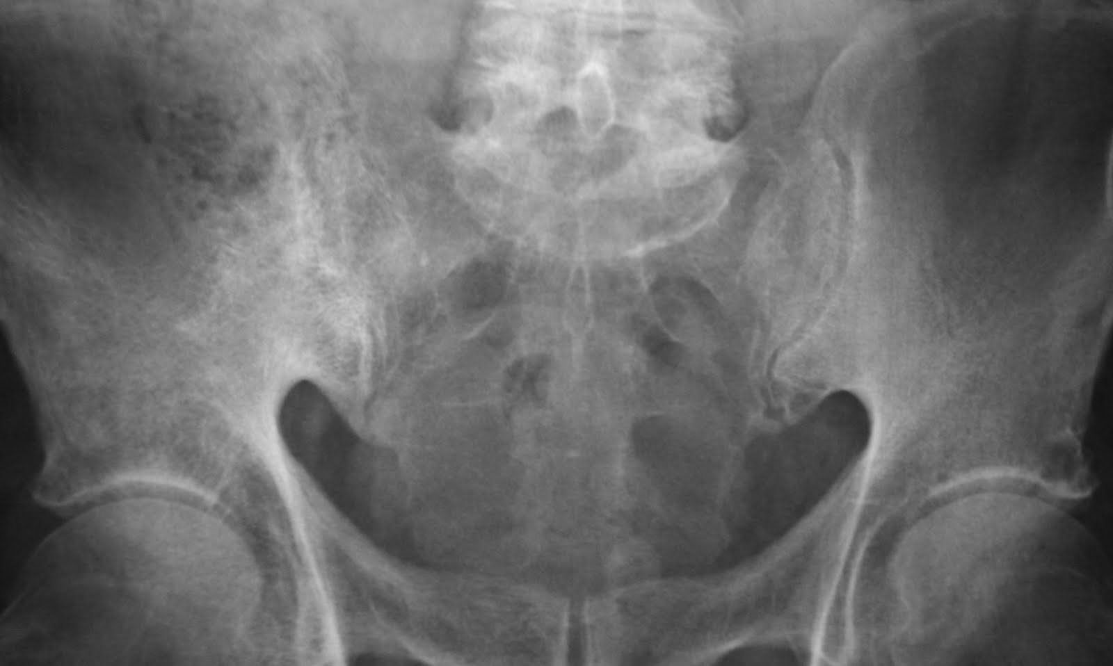 Daily Dose Paget's disease