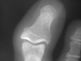 toe distal phalanx fracture base dose daily ultrasound confirmed plain seen film well