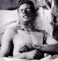 mustard gas, burn, u.s., soldier, experiment