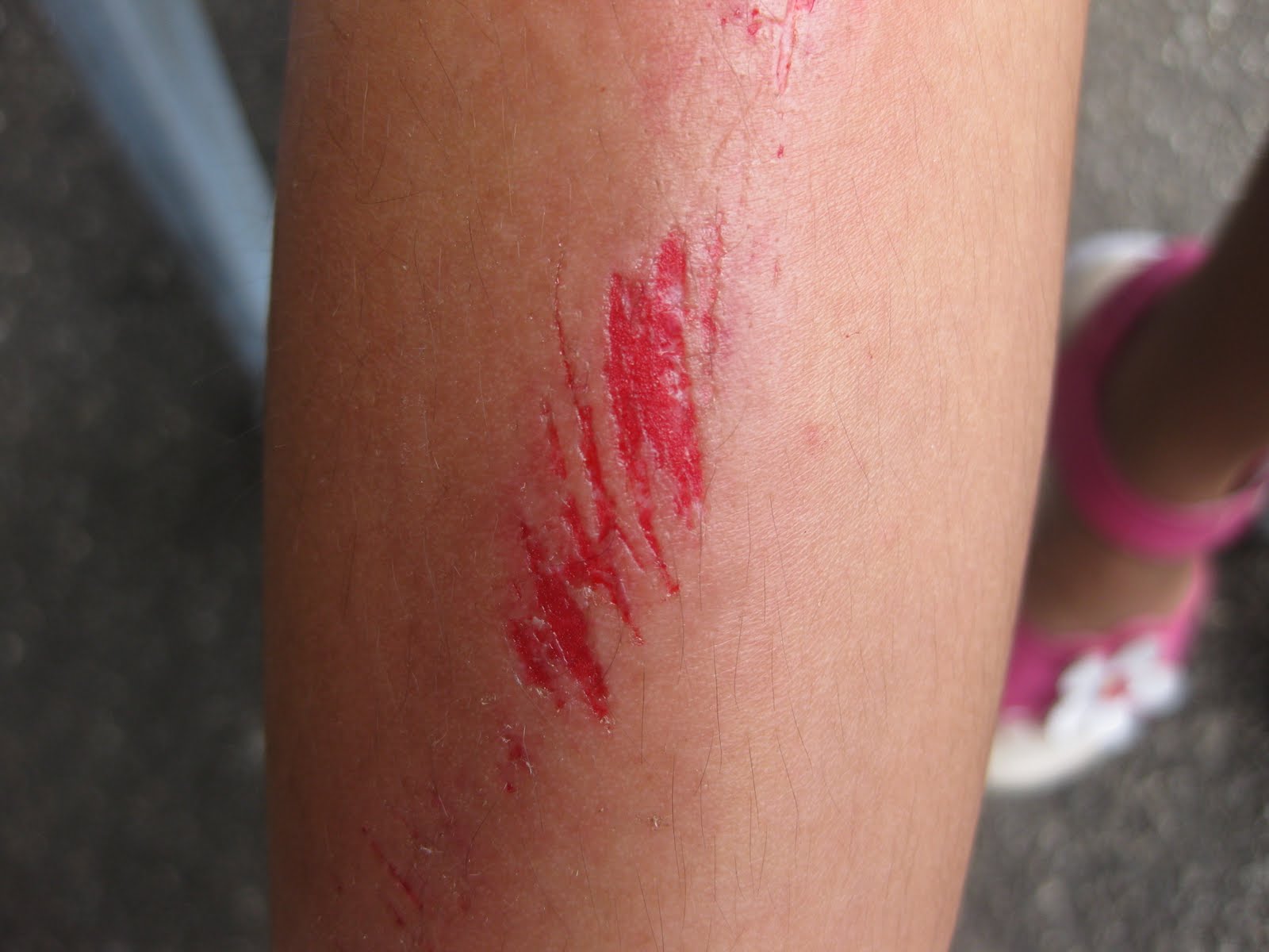 Sabrina's scratch 擦伤her legs during JB Trip