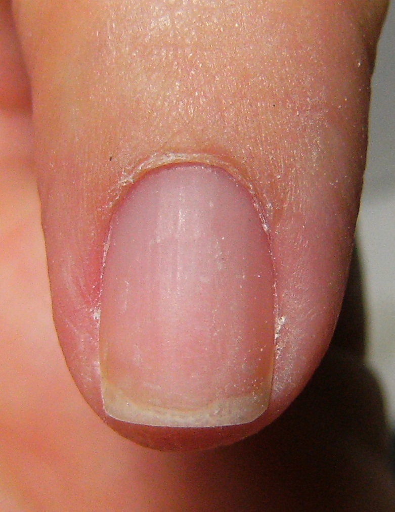 Fingernail disorders, fingernail changes, fingernail ...