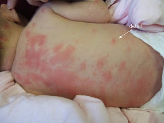 Hives (Urticaria) in an Infant or a Baby: Condition ...