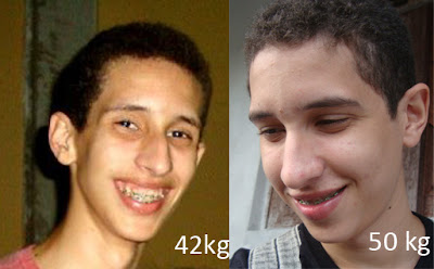 Meu Amigo Crohn: Antes e Depois [2]