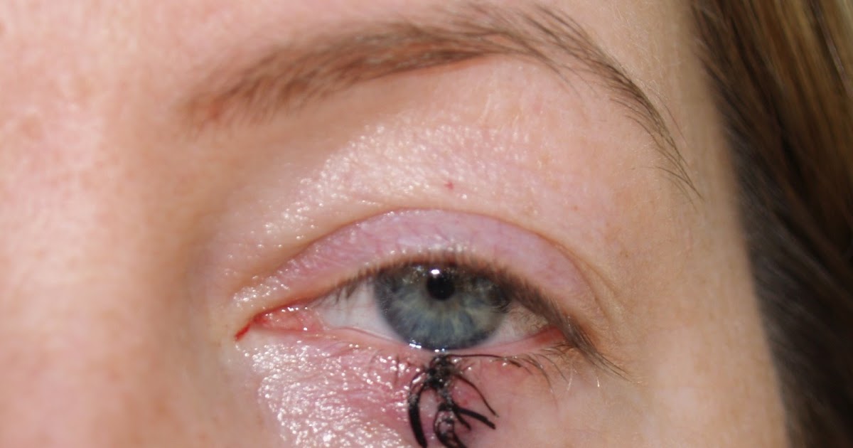 Design 45 of Bed Bug Bite On Eyelid Pictures | waridhellotones