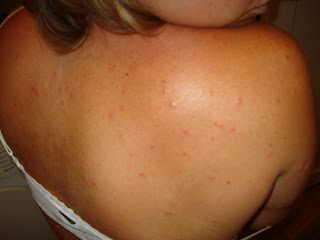 DSC01554 - Inga dåliga myggbett