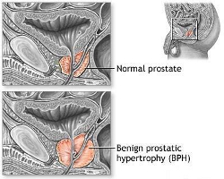 Se îmbunătățește erecția după masajul prostatei