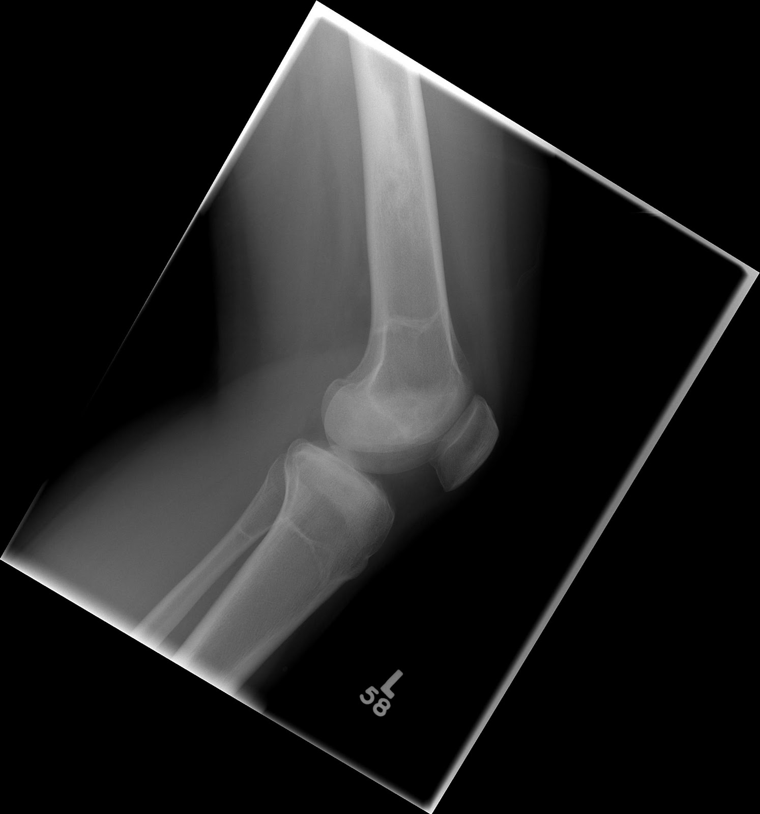 Post gad bone infarction sle 