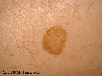 flat brown spots on skin - pictures, photos
