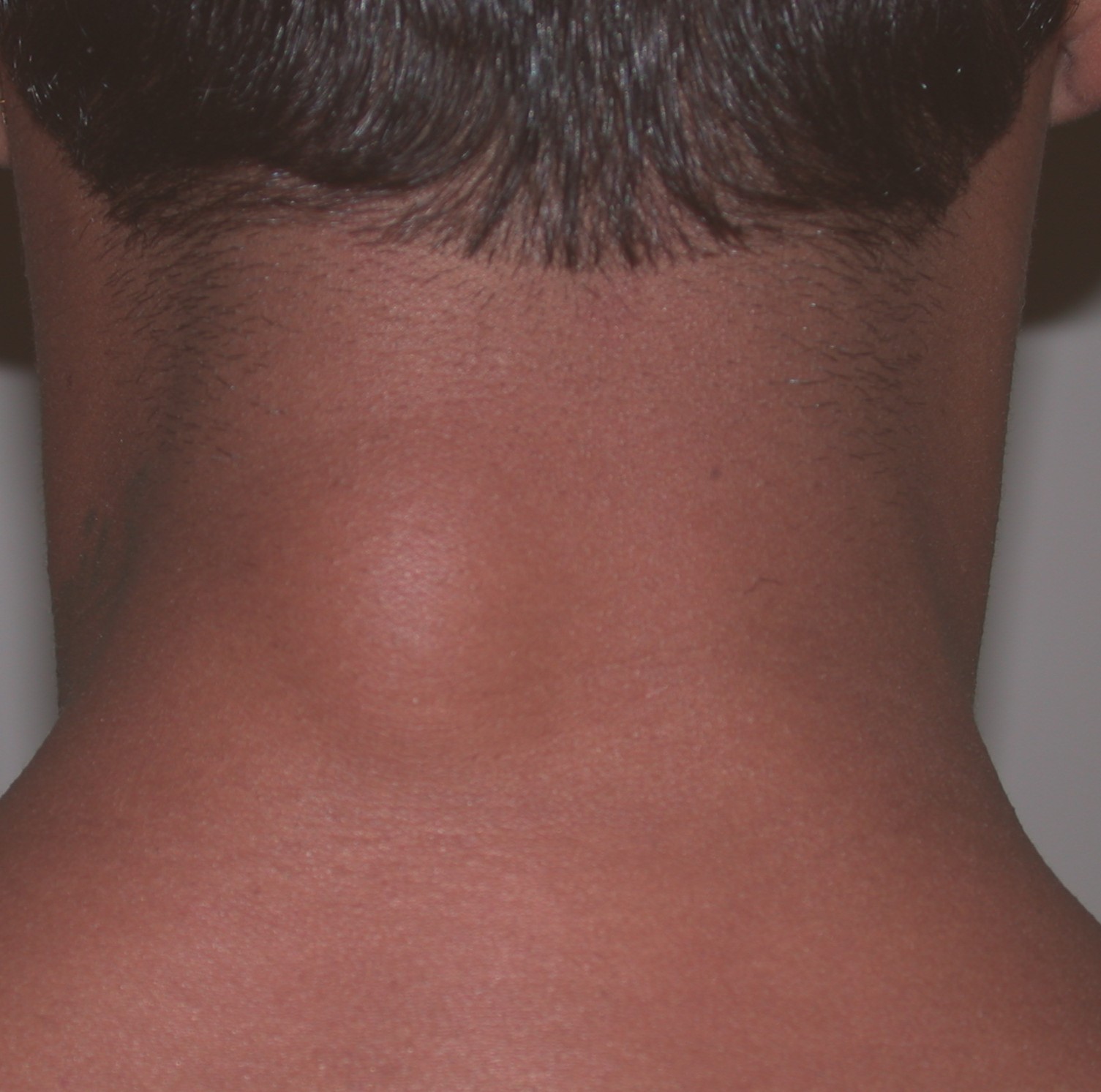 Back Of Neck Fat 56