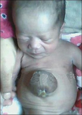 [baby+born+with+heart+in+stomach.jpg]