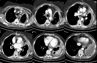 CT2009: Diagnosis: Malignant Mesothelioma With Contrast CT Chest Images