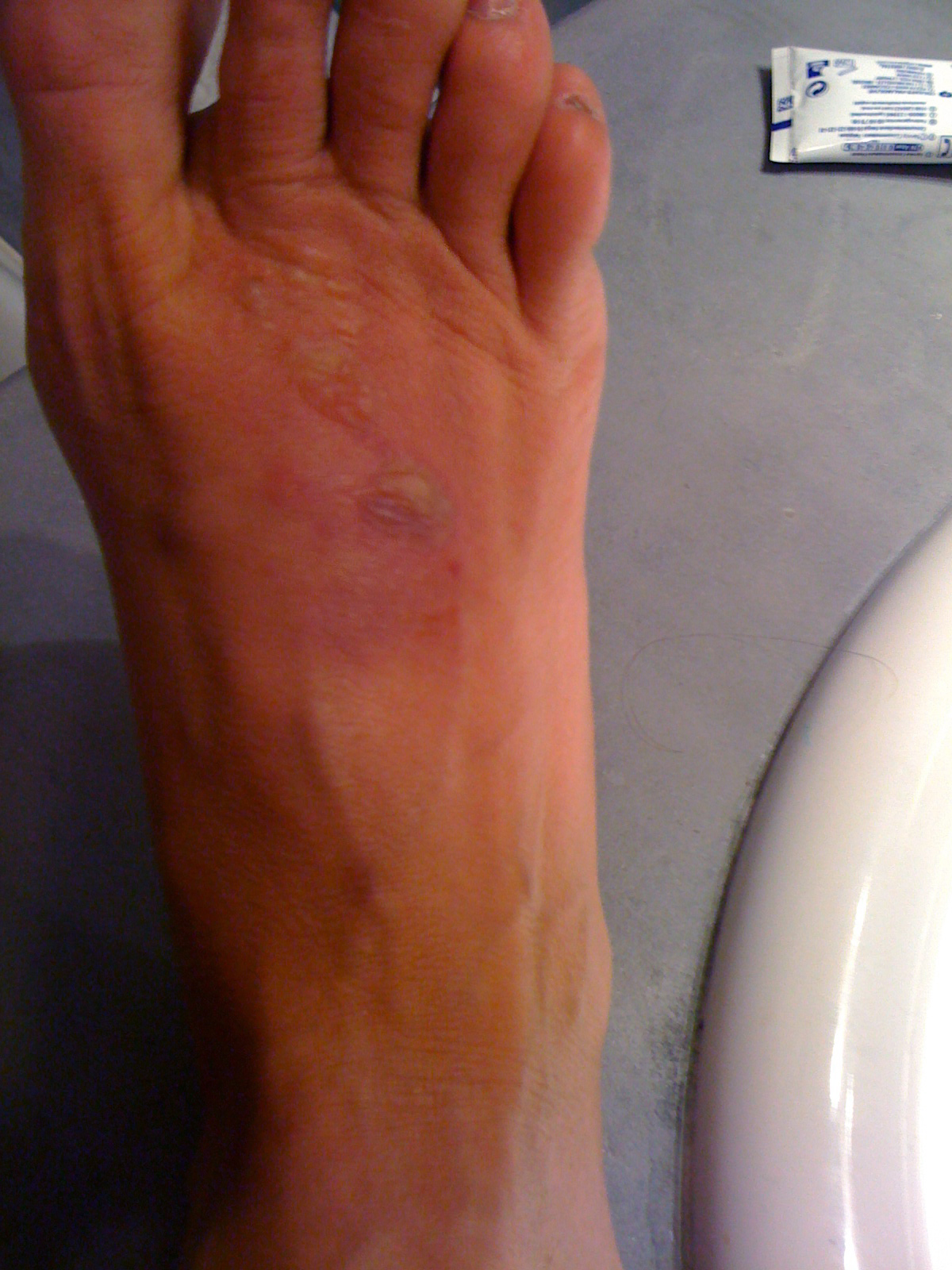 Baynes Family spider bite