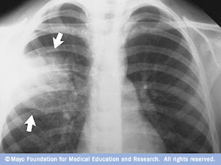 Lung Diseases And Disorders This Prevents A Person From Inhaling Dust Or Mold Lung X Ray Can Determine If Has Pneumonia Doctor May Also Listen To Abnormal Breathing