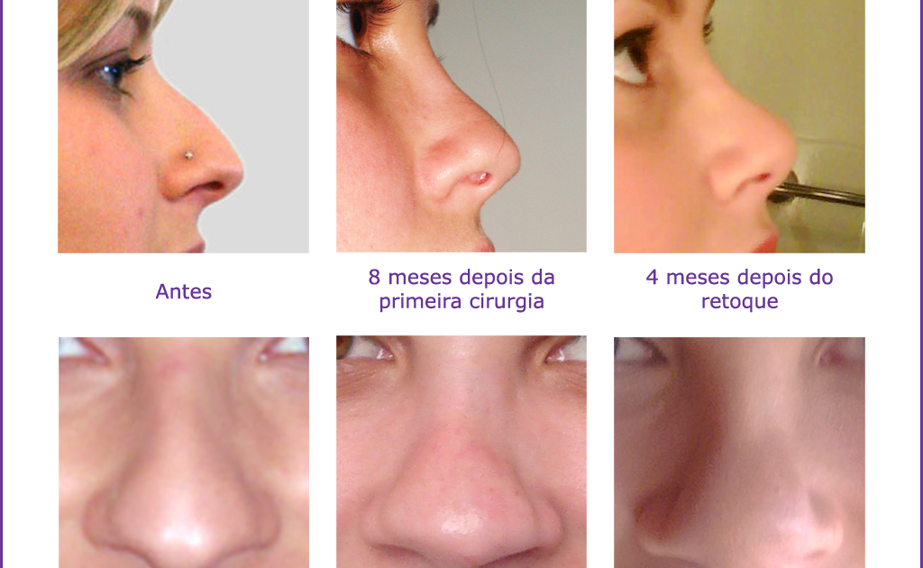 Diário de uma rinoplastia: Antes e depois