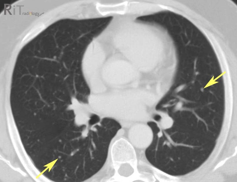 Thyroid cancer lung metastasis