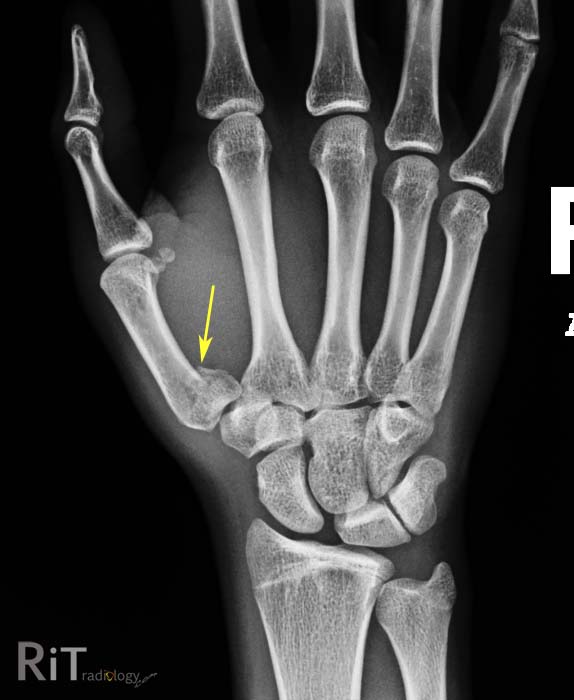 RiT radiology: Bennett #39 s Fracture Dislocation RiT radiology: Bennett #39 s Fracture Dislocation