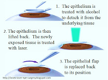 LASEK laser eye surgery
