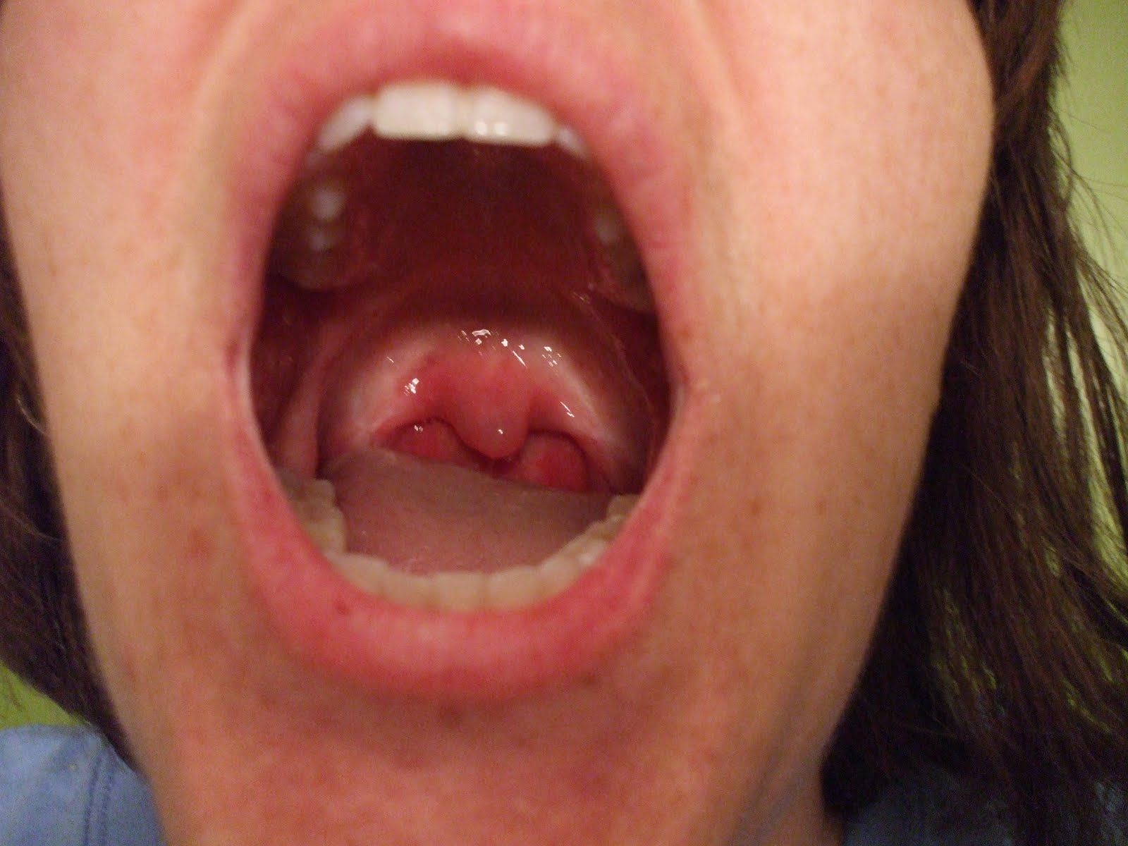 Throat Swollen Uvula 80