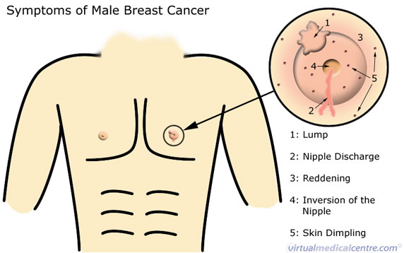 [male+breast+cancer.jpg]